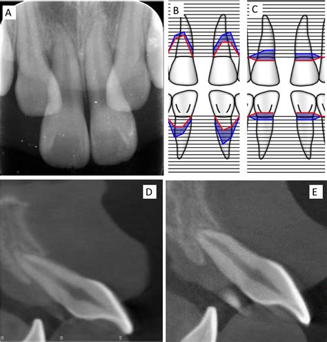 Light Force And Multidisciplinary Approach For Large Scale Retraction And Intrusion Of Maxillary