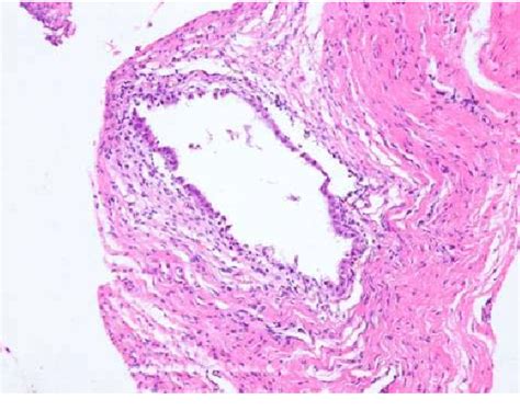 Figure 1 From Two Cases Of Extrapelvic Endometriosis Following