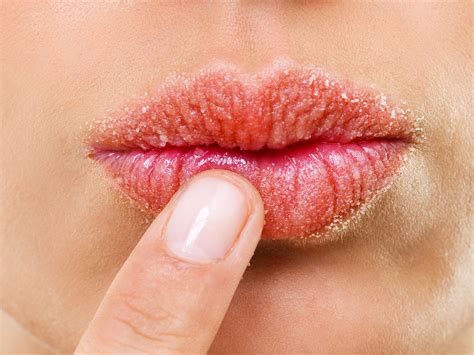 What Is The Main Cause Of Chapped Lips