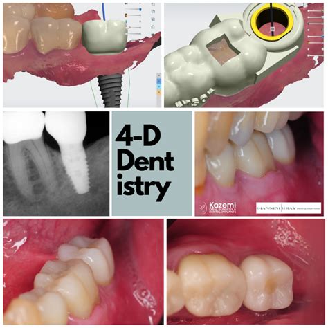 Lower Second Molar Replacement With Dental Implant Lower Second Molar