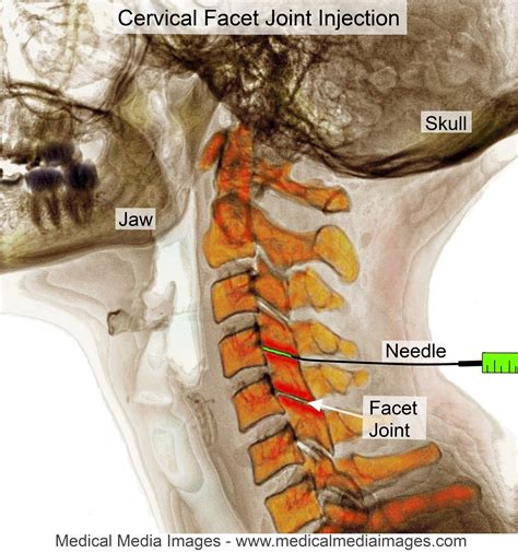 A Color X Ray Of The Neck Cervical Spine Which Shows A Injection Of