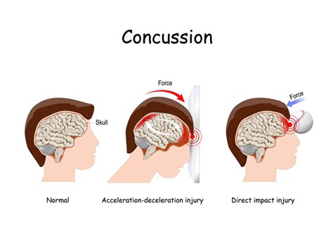Concussions In Women Can Have Lasting Effects Premier Neurology
