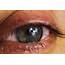 What Are The Causes Of Watery Eyes  Step To Health
