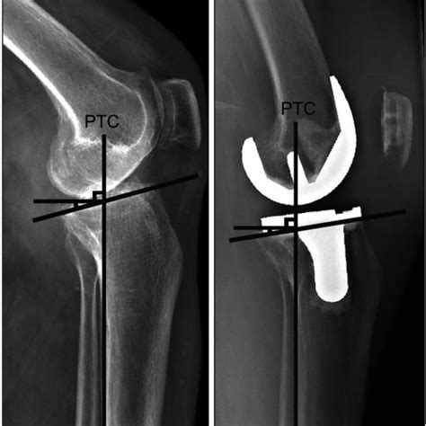 Pdf Effect Of Posterior Femoral Condylar Offset And Posterior Tibial Slope On Maximal Flexion
