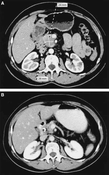 A An Abdominal Ct Scan Performed Before Chemotherapy Showing A Tumour