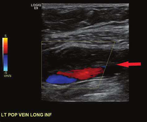 Duplex Ultrasound In Upper And Lower Limb Deep Venous Thrombosis My XXX Hot Girl