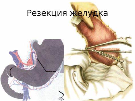 Диета послеоперационная при резекции желудка Диета После Резекции Желудка По Бильрот 2 — Похудение Диета Правильное Диета После Резекции Желудка По Бильрот 2 — Похудение Диета Правильное Диета послеоперационная при резекции желудка