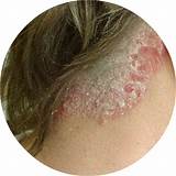 Pictures of Scalp Ringworm Medication