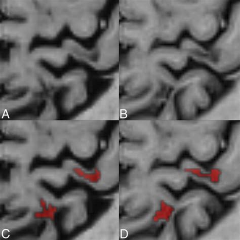 Detection Of Leukocortical Lesions In Multiple Sclerosis And Their