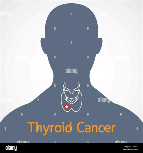 Thyroid Cancer High Resolution Stock Photography And Images Alamy