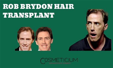 Fellow irishman james also visited hrbr after his hair loss became an obsession which he felt would impact on his career. Rob Brydon's Hair Transplantation | Before & After Photos ...