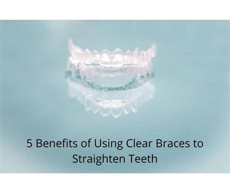 5 Benefits Of Using Clear Braces