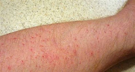 10 Causes Of Itchy Legs And How To Deal With It Itchy Legs Itchy