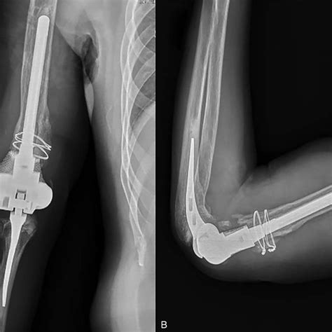 8 Classification Of Fractures Of The Distal Humerusa Ao Classification