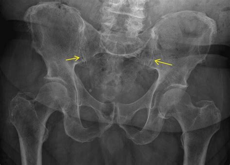 Anterior Posterior Radiograph Of Pelvis Showing Joint Space Narrowing