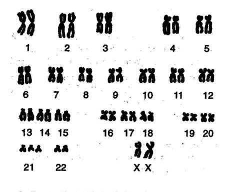 In 1866, a physician named john langdon down published an essay in england in which he described a group of children with common features who were different from other children with mental retardation. Down Syndrome karyotype (trisomy 21): chromosomal condition caused by the presence of all or ...