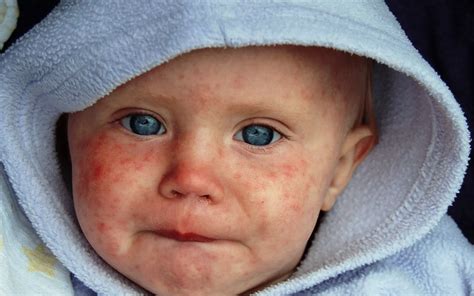 Measles Causes Symptoms Diagnosis And Treatment Medic Journal
