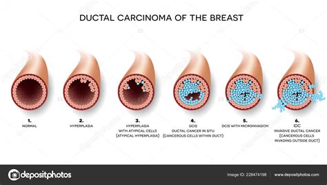 Invasive Ductal Carcinoma Symptoms
