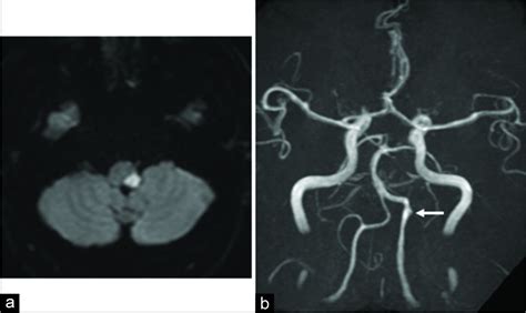 Vertebral Artery Dissection Spectrum Of Imaging Findi Vrogue Co
