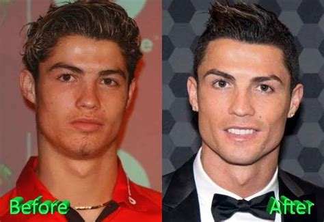 Do You Now Ronaldo S Jaw Surgery Or Exercise R Orthotropics