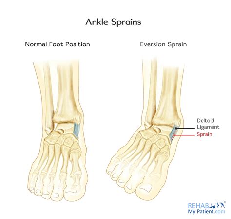 Ankle Sprain Rehab Me