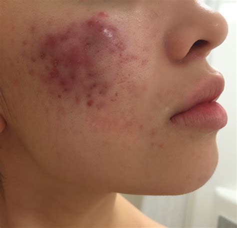 Please Help Interconnected Acne Cysts Prescription Acne Medications