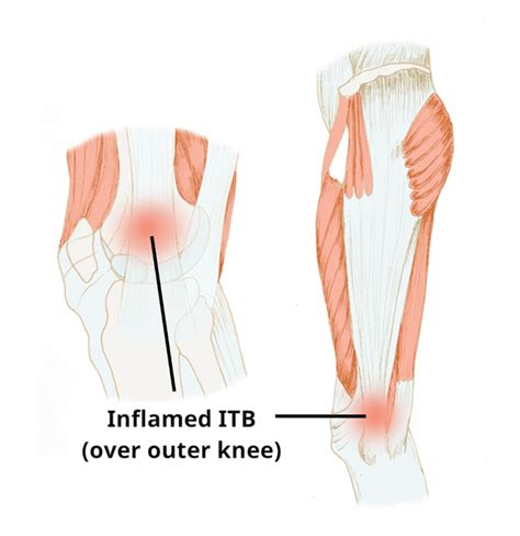Iliotibial Band ITB Syndrome Circle Integrated Care