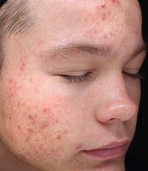 Seasonal Acne Prevent Spring And Summer Breakouts Medspa Nyc
