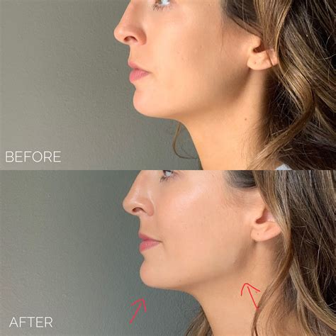 Chin And Jaw Fillers In Dallas Before And After Photos