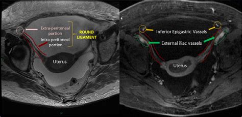 Deep Endometriosis Dont Forget About Round Ligaments Mri Features Clinical And Anatomic