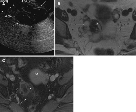 Multimodality Imaging Of Ovarian Cystic Lesions Review With An Imaging
