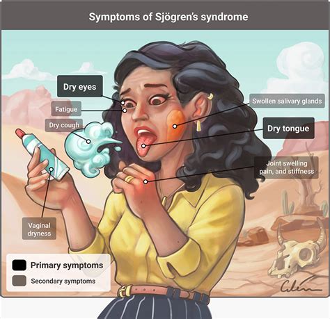 Diagnosing Sjögrens Syndrome With Salivary Gland Ultrasound Research
