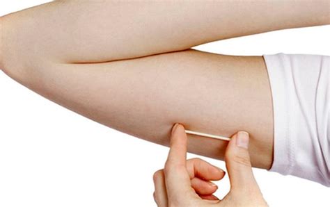 Anticonceptivo implantado en el brazo termina en el pulmón de una mujer