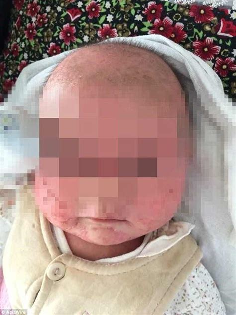 Baby Covered In Blisters After Her Herpes Infected Mother Kissed Her