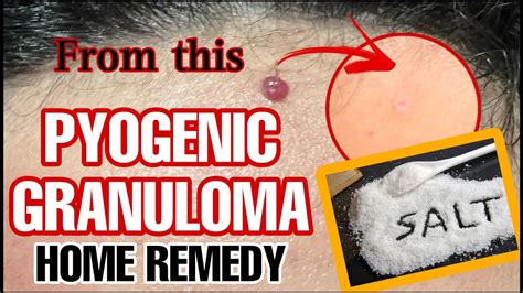 Pyogenic Granuloma Home Remedy 100 Effective Step By Step