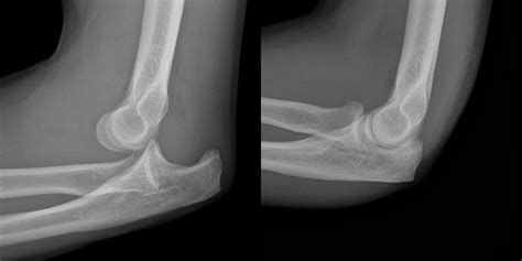 Trauma X Ray Upper Limb Gallery 1 Elbow Dislocation