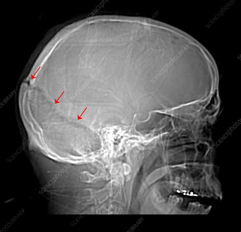 Skull Fracture On X Ray Stock Image C0271705 Science Photo Library