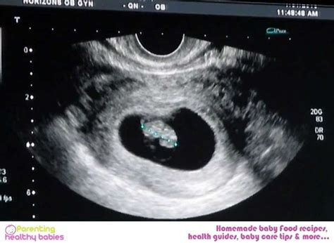 2 Months Pregnant Baby Ultrasound Pictures Baby Viewer