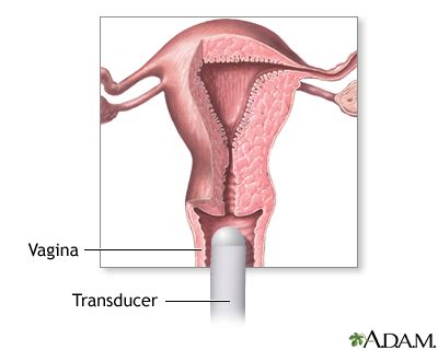 Transvaginal Ultrasound Medlineplus Medical Encyclopedia Image