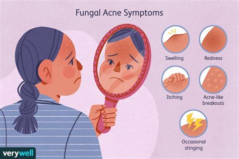 Fungal Acne Causes And Treatments
