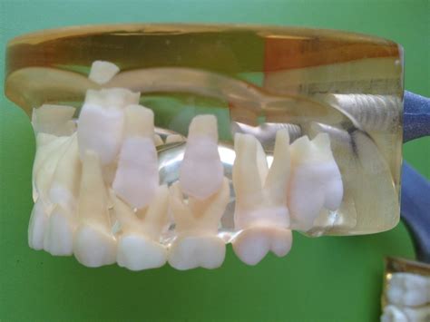 Mixed Dentition Upper Jaw Dental Hygiene Dental Hygiene