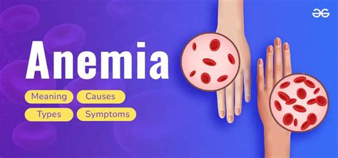 Anemia Overview Meaning Causes Types And Symptoms Geeksforgeeks