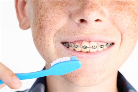 Tips To Prepare Your Child For Braces Markham Orthodontics