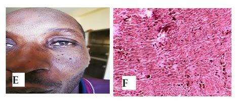 A Preoperative Appearance Of The Tumor B Ct Appearance Showing The