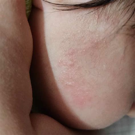 Baby Is 4 Months Old And Has Dry Light Redish Skin Rash On His Face