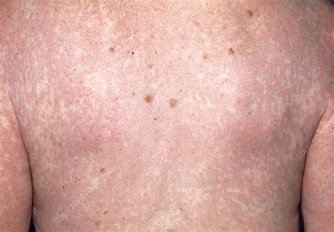 Rash Over Back Due To Allergy To Carbamazepine Stock Image M320