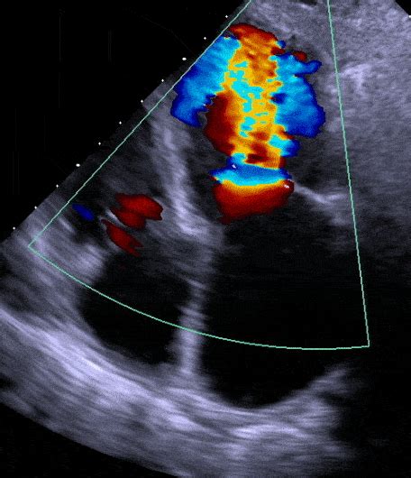 Echocardiogram Vs Ekg Explained By A Cardiologist Myheart