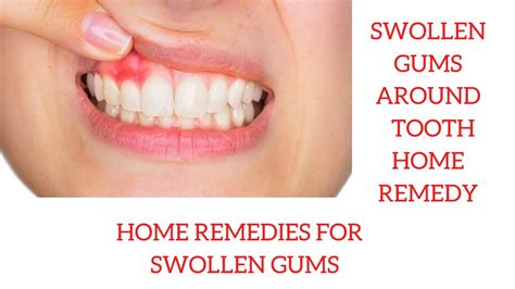 Home Remes To Heal Inflamed Gums My Bios