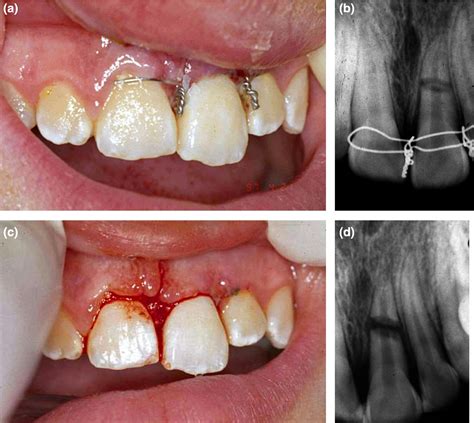 And broken and dislodged teeth. Splinting of teeth following trauma: a review and a new splinting recommendation - Kahler - 2016 ...