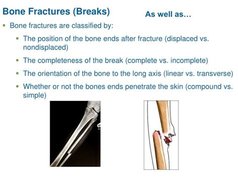 Ppt Bone Fractures Breaks Powerpoint Presentation Free Download